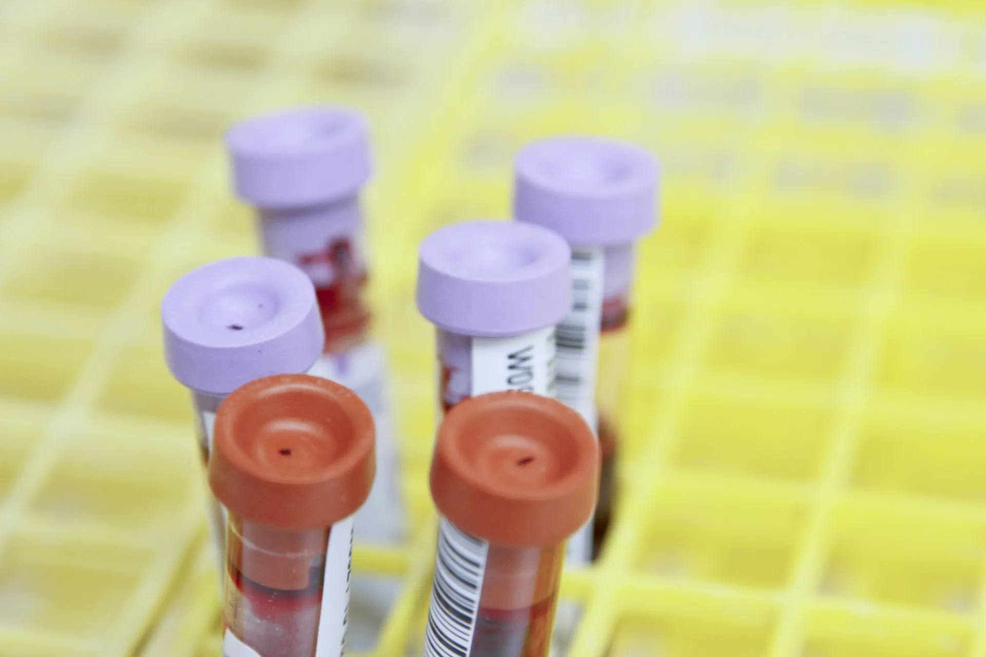 Kraujo mėginiai laboratorijoje cholesterolio tyrimui — lipidograma yra pagrindinis būdas atpažinti padidėjusį cholesterolį ir širdies ir kraujagyslių ligų riziką